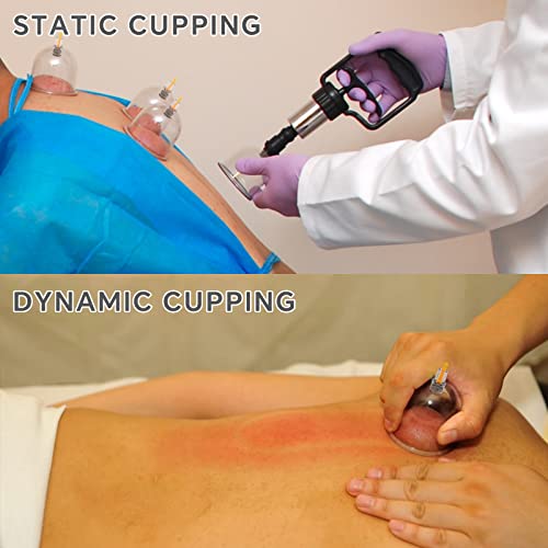 Best image of cupping sets